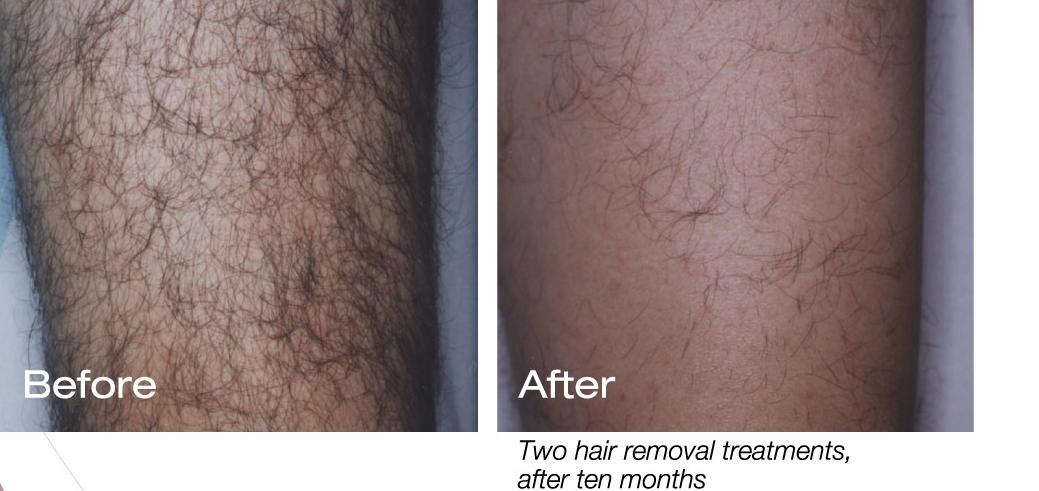 Difference Between Bikini And Brazilian Laser Hair Removal